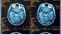Imatge d'una ressonància magnètica d'un cervell, per diagnosticar l'Alzheimer
