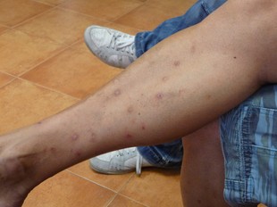 Efectes de les picades de mosquit tigre a la cama d'un jove de Calella. T.M