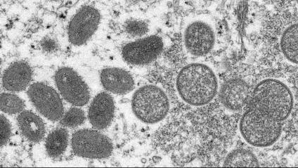 El virus de la verola del mico vist amb tomografia computeritzada